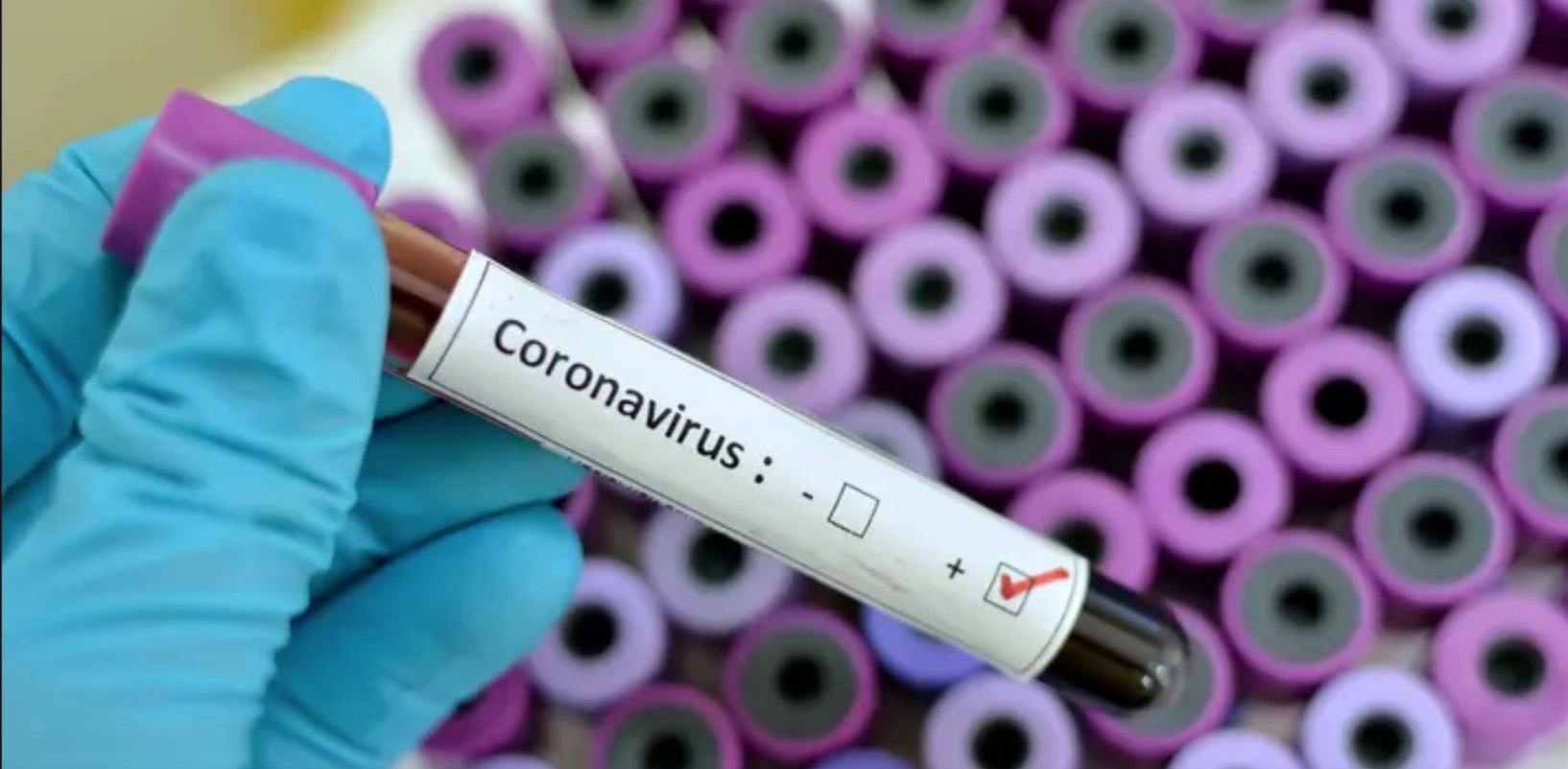 Amapá confirma 1º caso positivo de coronavírus, diz governo