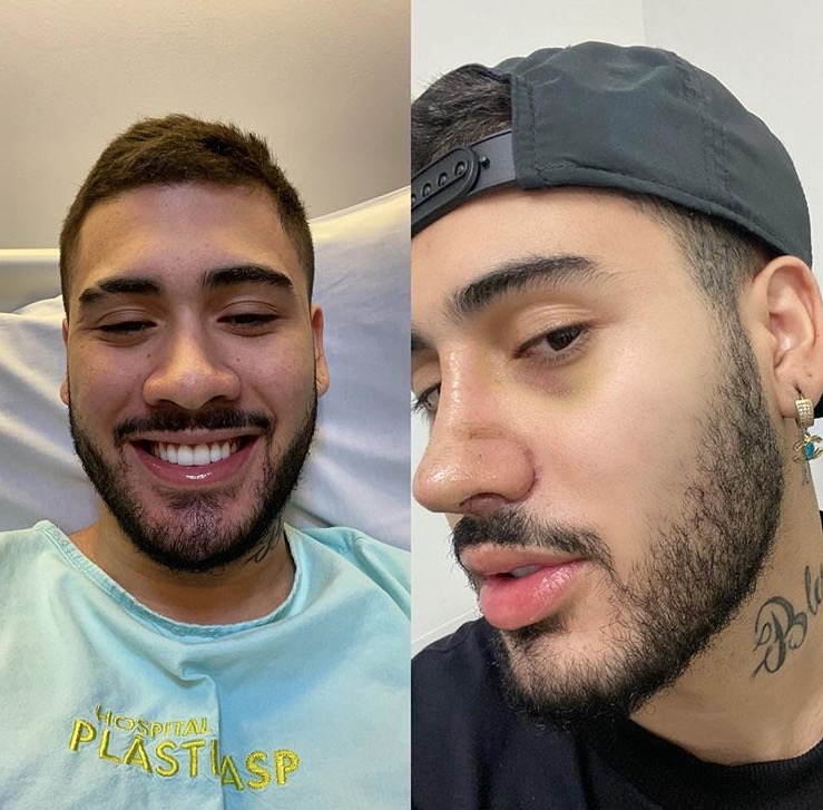 Kevinho faz cirurgia plástica no nariz e exibe resultado