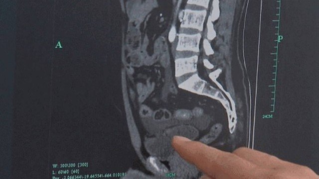 Homem tem bexiga estourada após ingerir bebida alcoólica e não urinar