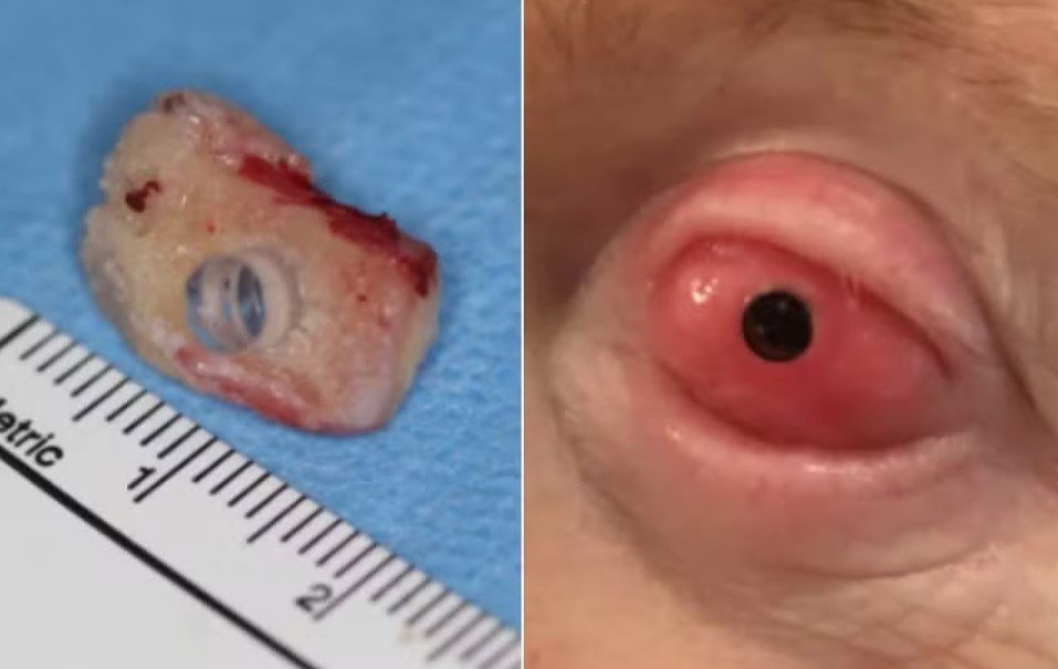 Médico implanta dente no olho para restaurar visão de paciente