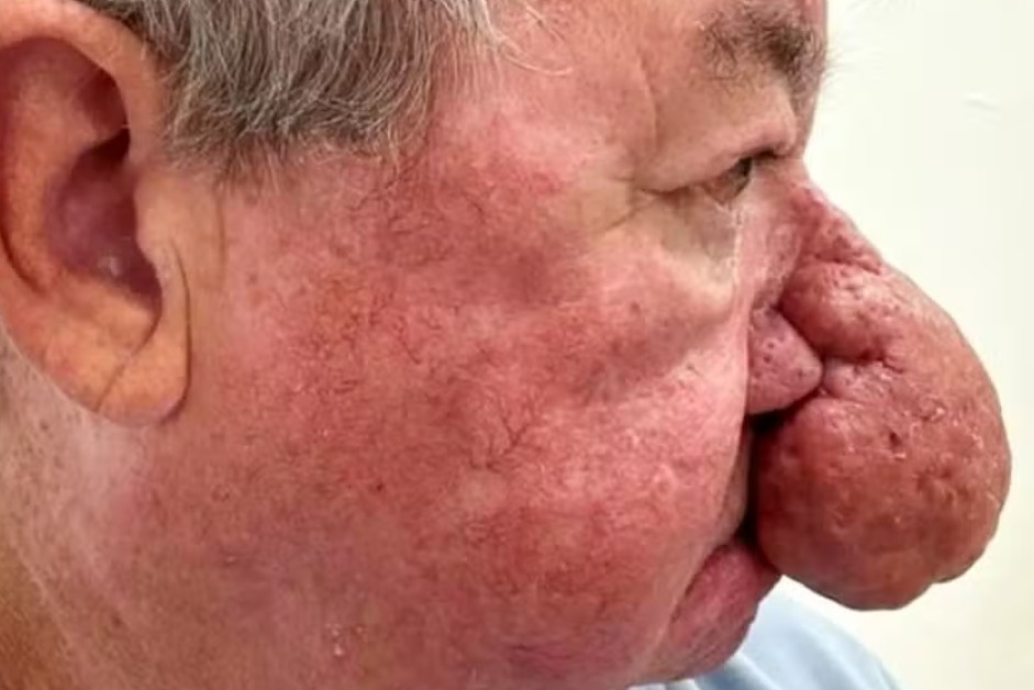 Escocês celebra cirurgia que o permitiu voltar a beijar a esposa