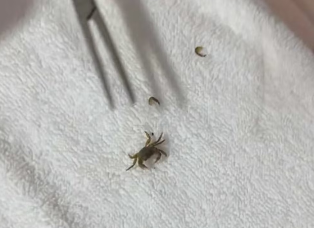 Caranguejo é retirado de dentro da orelha de criança após dia de praia