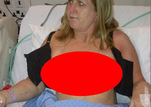 Silicone explode e mulher precisa reconstituir as mamas