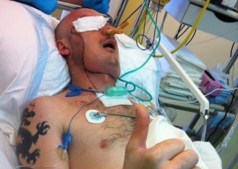 Polônia realiza primeiro transplante de rosto de 'emergência'