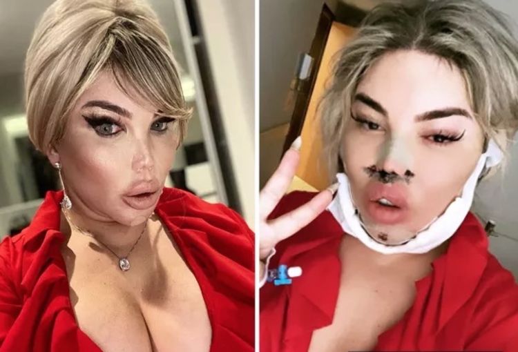 Brasileira passou por novos procedimentos estéticos/ Foto: Reprodução/ Instagram