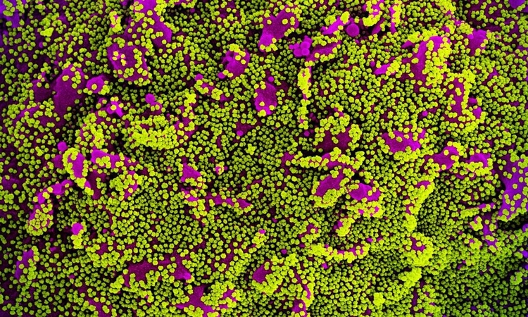 Imagem ilustrativa. - Amostra de células de um paciente infectado pelo coronavírus. Foto: NIAID/NIH