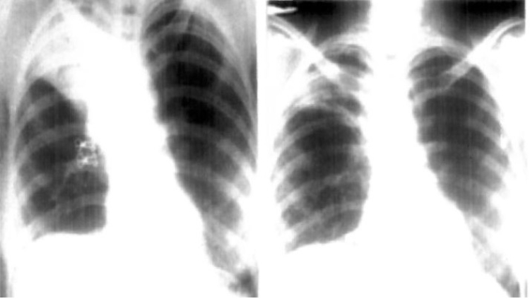 Mulher ficou com o objeto no pulmão por 4 meses / Foto: Reprodução/C. L. Arya, R. Gupta, V. Arora/Semantic Scholar