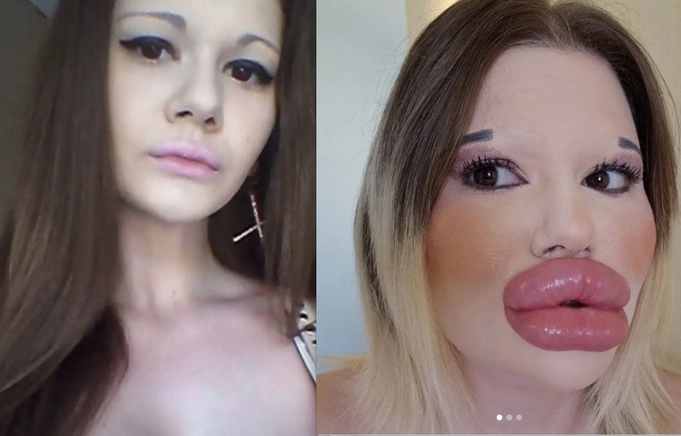 Andrea antes e depois dos procedimentos - Foto: Reprodução Instagram