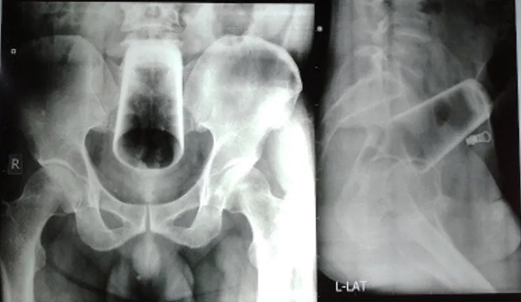 Imagem: Reprodução/Journal of Nepal Medical Association