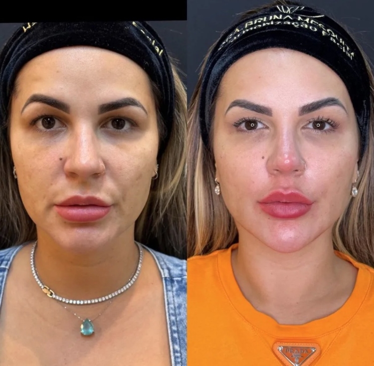 Antes e depois Deolane Bezerra - Foto: Reprodução/Instagram