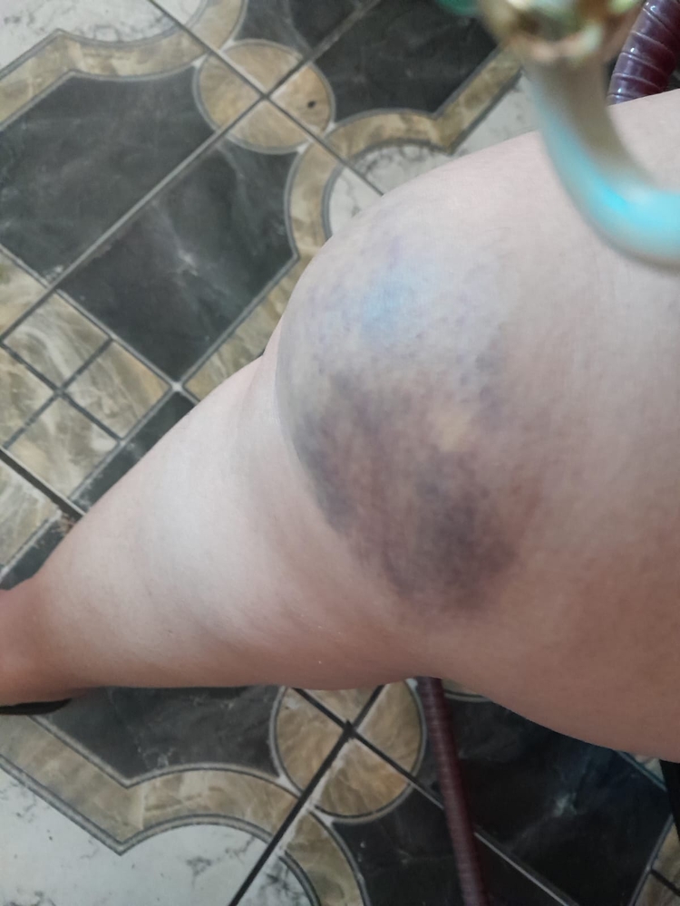Suzielem sofreu hematomas e ferimentos na cabeça - Foto: Arquivo pessoal