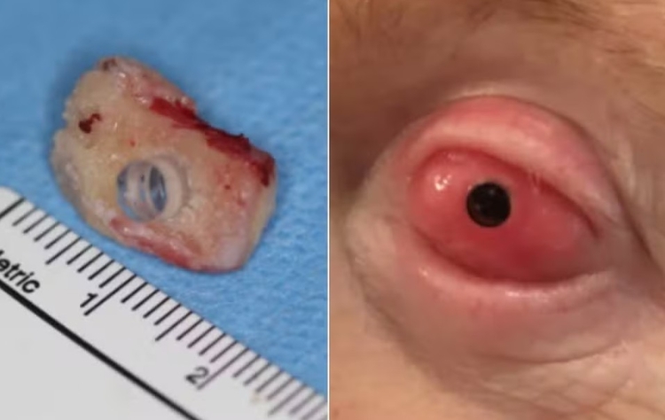 Brent se submeteu a implante de um dente num dos seus olhos - Foto: Reprodução