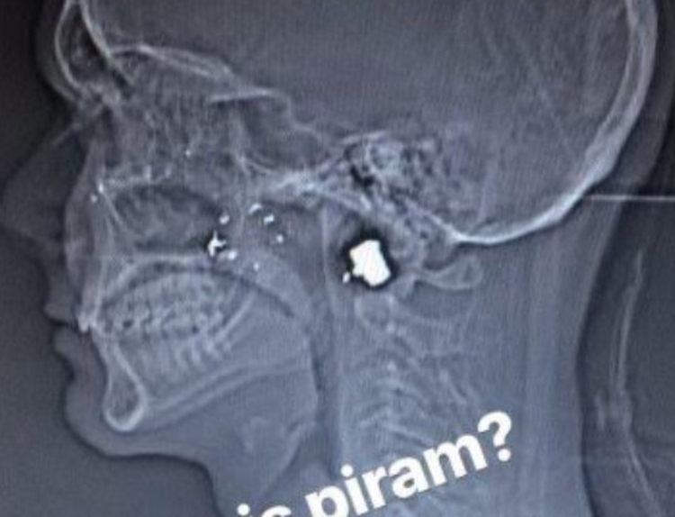 Foto: Divulgação / Bala permanece alojada no crânio dele