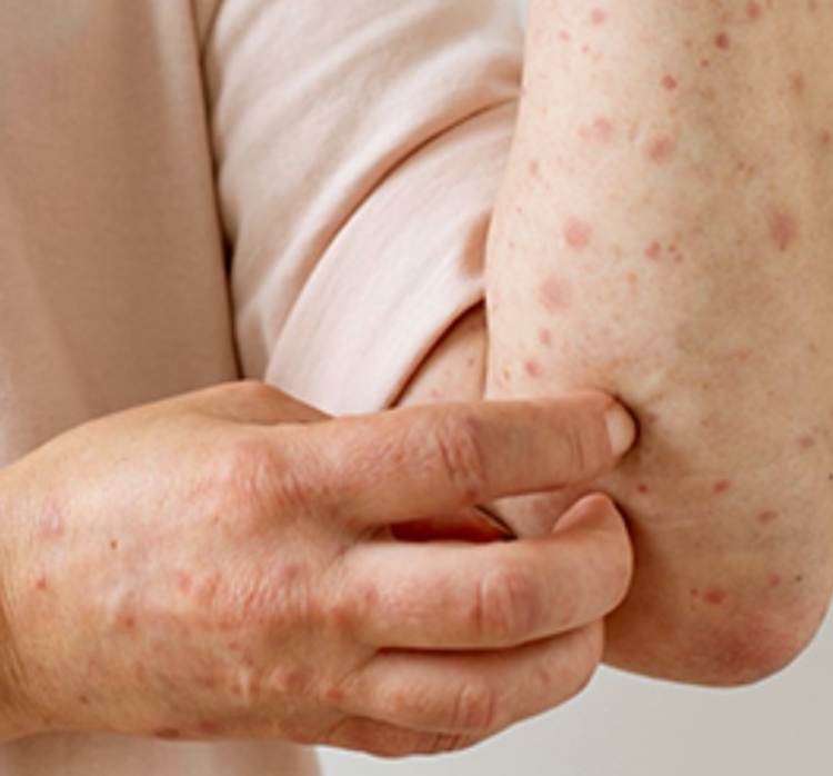 Mpox - Foto: Divulgação Governo