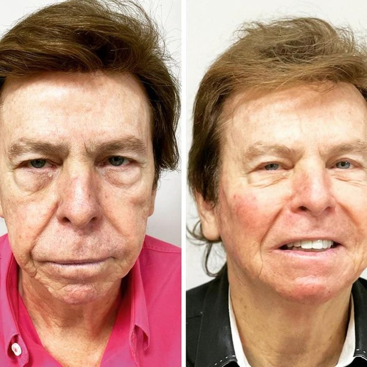 Antes e Depois de Nelson Rubens - Foto: Reprodução/ Instagram