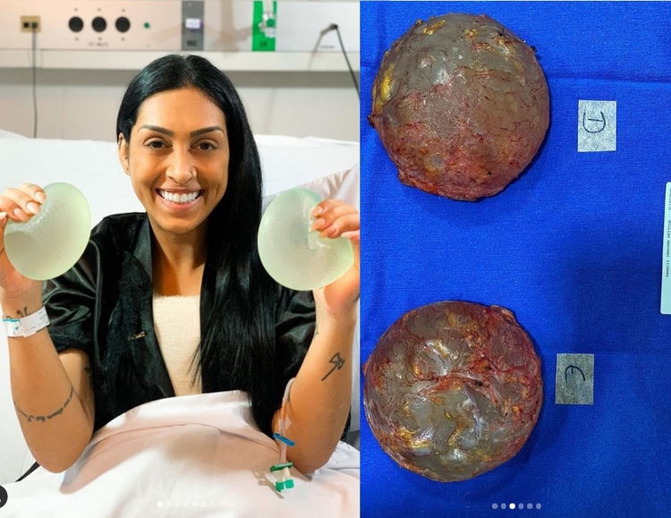 Próteses causavam dores e outros sintomas. - Foto: Reprodução/Instagram