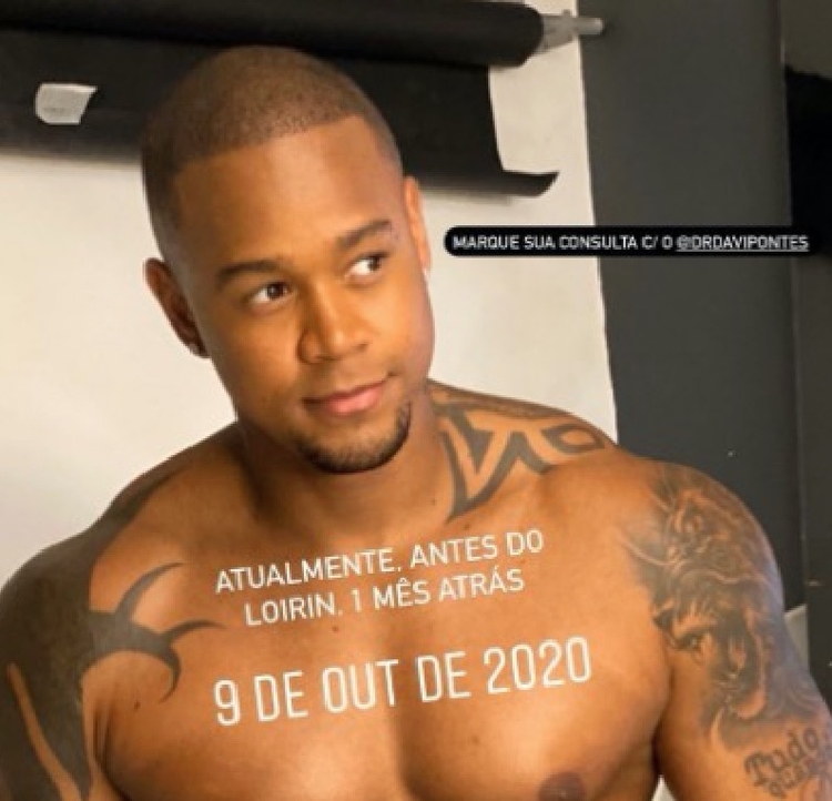 Cantor mostrou evolução entre as sessões do transplante capilar. - Foto: Reprodução/Instagram