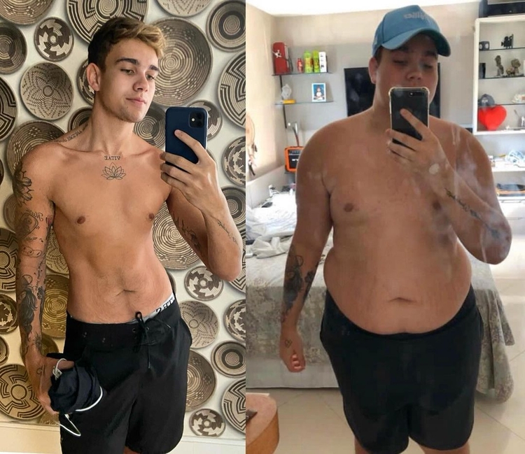 Rafael Almeida em foto de antes e depois de cirurgia -  Foto: Reprodução/ Instagram