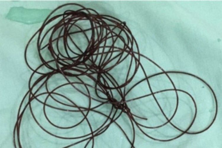 Imagem: Reprodução/Radiology Case Reports/Dr.Soetomo General-Academic Hospital    