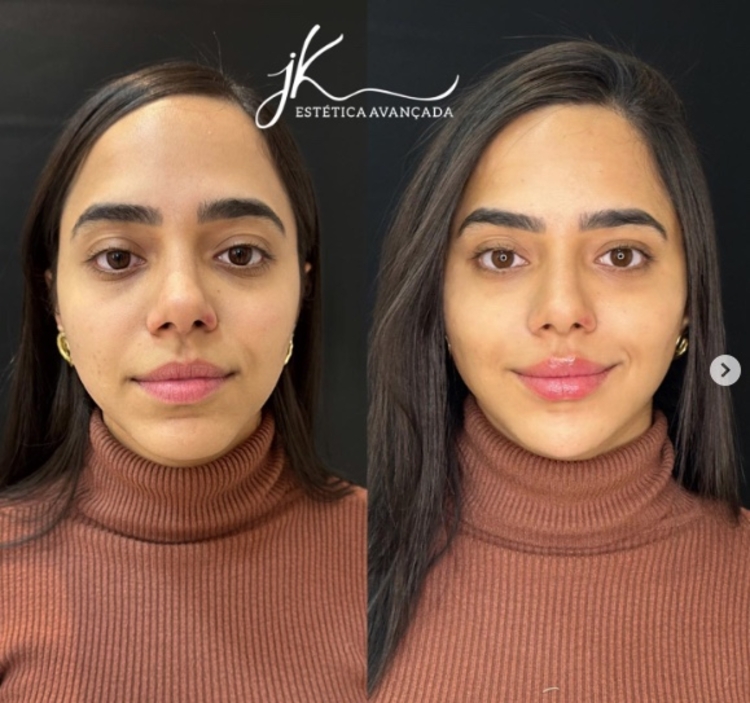 Antes e depois Mariely - Foto: Reprodução/Instagram Jk Estética Avançada 
