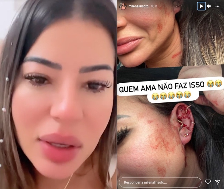 Milena Lins relata que foi agredida e mostra machucados - Foto: Reprodução/Instagram