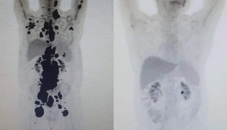 Imagem mostra antes e depois do tratamento do paciente Paulo Peregrino / Foto: Arquivo pessoal