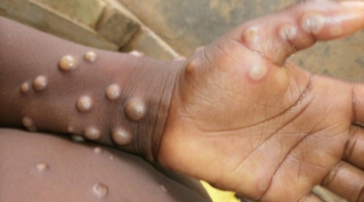 Casos de varíola dos macacos / Foto ilustrativa: OMS/Nigeria Center for Disease Control