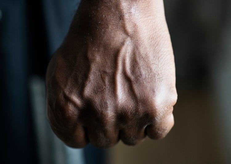 Vítima tinha hematomas - Foto: Freepik