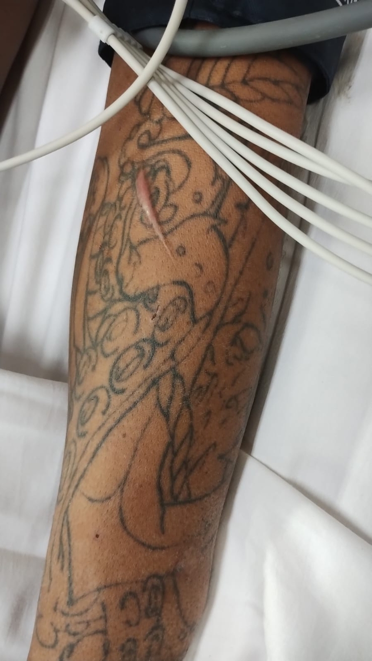 Imagem da tatuagem do paciente para reconhecimento / Foto: Divulgação