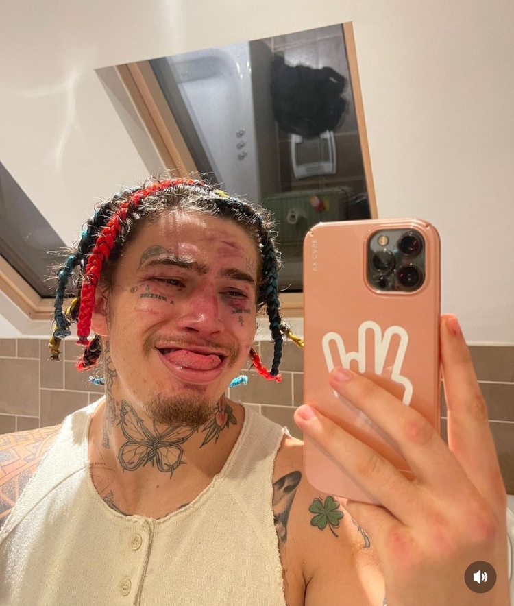 Whindersson com rosto machucado pós luta - Foto: Reprodução/Instagram