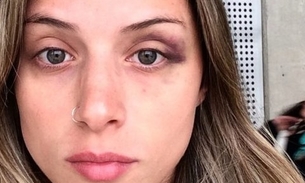  Bailarina do Faustão mostra hematomas de briga com Yuri e conta detalhes