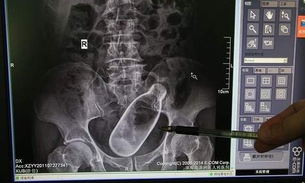 Homem estimulou o ânus com garrafa para ajudar na prisão de ventre 