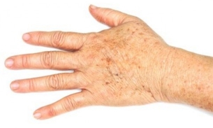  Apenas uma gota de óleo essencial para eliminar as manchas da pele