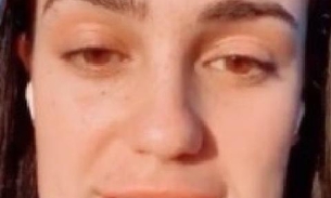 Deu ruim! Jovem fica com o rosto bizarro após procedimento estético 