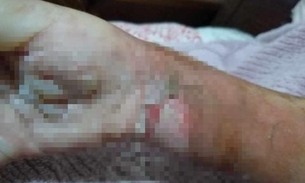 Celular explode e criança de 5 anos fica em 'chamas'