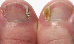 Mitos e verdades sobre a micose