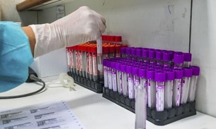 Trombose em pequenos vasos é característica de covid-19, diz estudo