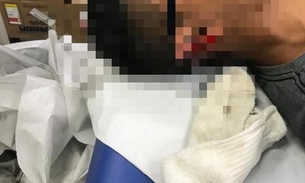 Jovem tem parte de orelha arrancada após ser baleado por assaltantes em Manaus