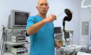 Bizarro: Médicos removem 'bolo' de cabelo gigante de estômago de criança
