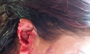 Mulher traída arranca orelha de amante do marido com mordida