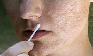 Confira as melhores máscaras faciais para acabar com sua espinhas