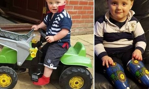  Diagnóstico errado faz com que menino de três anos tenha pernas e dedos amputados
