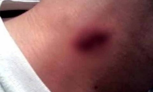 Jovem morre após levar chupão no pescoço