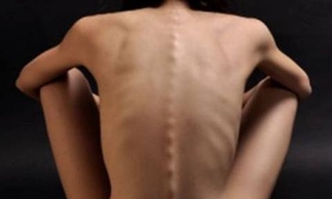 Especialistas alertam para os sintomas da Anorexia