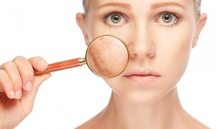 Anticoncepcional pode causar manchas na pele, saiba como evitar