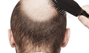 Fim da calvice pode estar próximo, diz cientistas