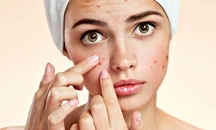Sua pele com acne de hoje pode ser a pele perfeita de amanhã naturalmente, dizem especialistas