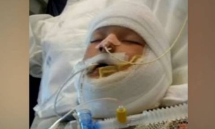 Garotos ateiam fogo em menino de 10 anos com necessidades especiais 