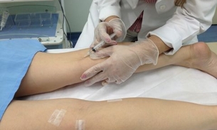 Tratamento à base de espuma ajuda a combater varizes