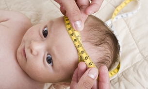 Bebês podem manifestar microcefalia meses após o nascimento  